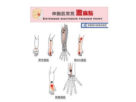 手指頭受傷|手肘痛、手腕痛、手指痛的原因,治療與自我檢查 » 台。